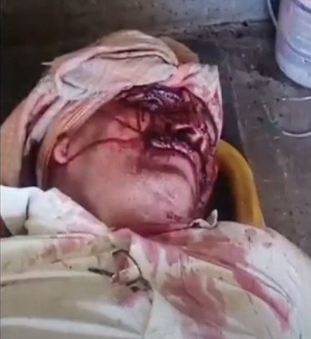 शराब दुकान पर दो पक्ष भिड़े, एक का कान काटा