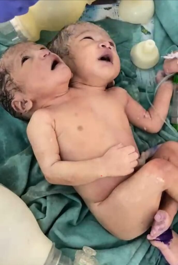 एमटीएच अस्पताल में सिर से जुड़े जुड़वां बच्चों का जन्म, डॉक्टर भी हैरान
