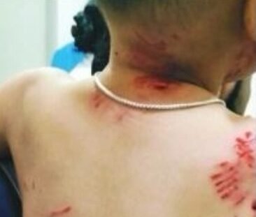 आवारा खूंखार श्वानों ने 2 साल के मासूम को नोंच डाला! 