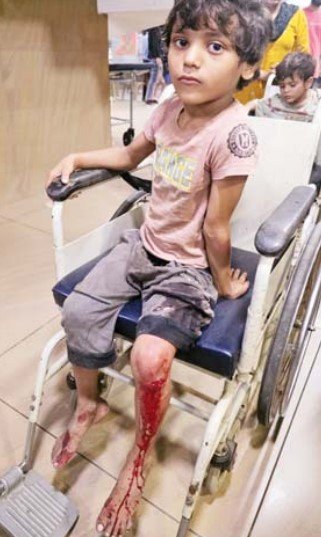 मोती तबेला में श्वानों का आतंक, बच्चों समेत 12 लोग बने शिकार, 7 गंभीर घायल