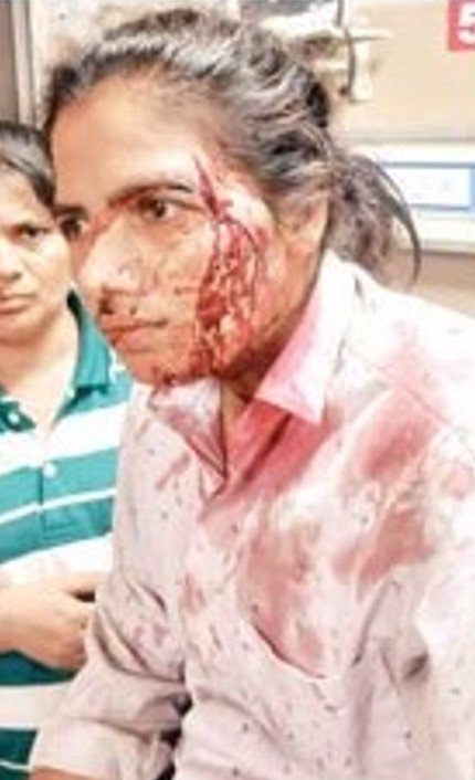 कार की टक्कर पर विरोध करना पड़ा महंगा, युवती पर ईंट-ब्लॉक से हमला