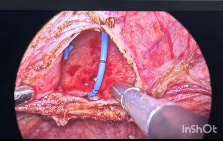 दुर्लभ VVF सर्जरी सरकारी अस्पताल में सफल, महिला को मिली नई जिंदगी