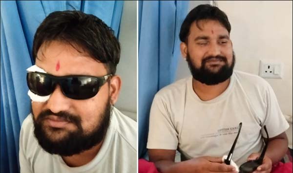 कार्बाइड गन से भोपाल में अब तक 186 घायल, मप्र में 300 पार; लगा पूर्ण प्रतिबंध, अस्पतालों में सर्जरी