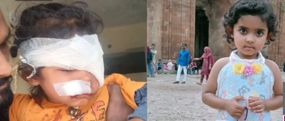 मासूम को आंगन से खींचकर ले गए स्ट्रीटडॉग, चेहरे-आंख के पास नोचा, 10 टांके आए
