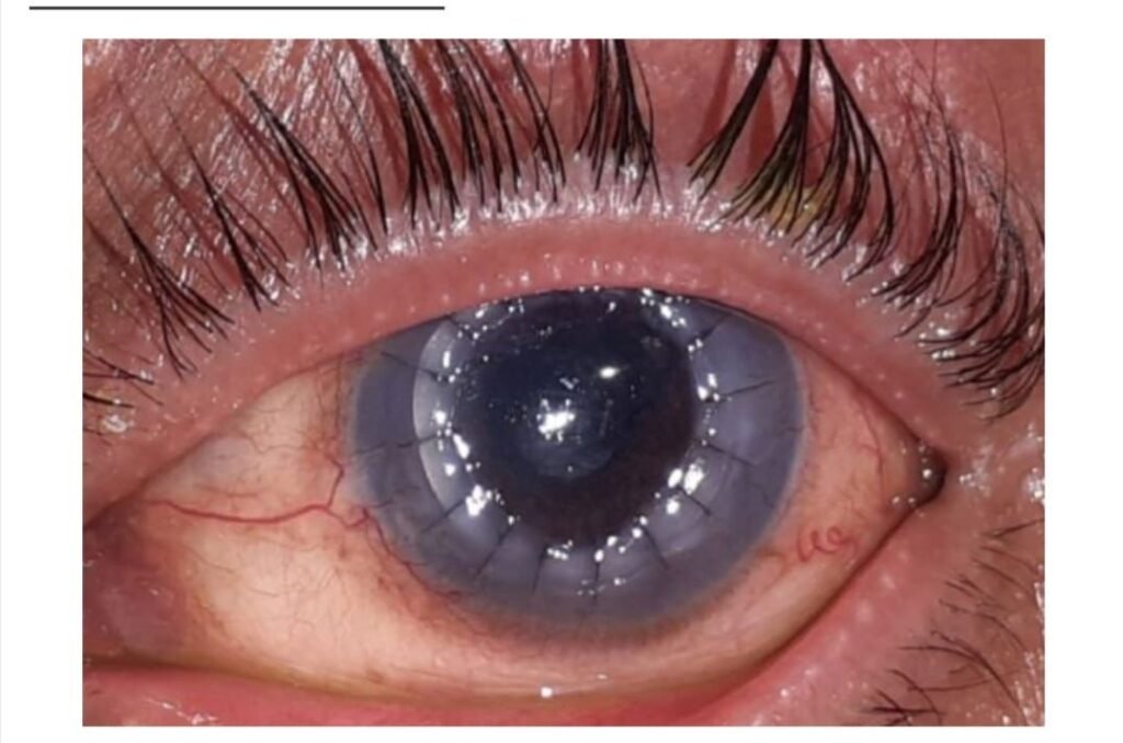 बीएमसी के चिकित्सकों ने सफल कॉर्नियल ट्रांसप्लांट से रोशन की दो व्यक्तियों की ज़िंदगी