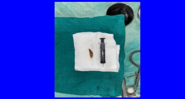 समय पर सर्जरी से बची युवक की जान, गले में फंसी चिकन की हड्डी निकाली गई