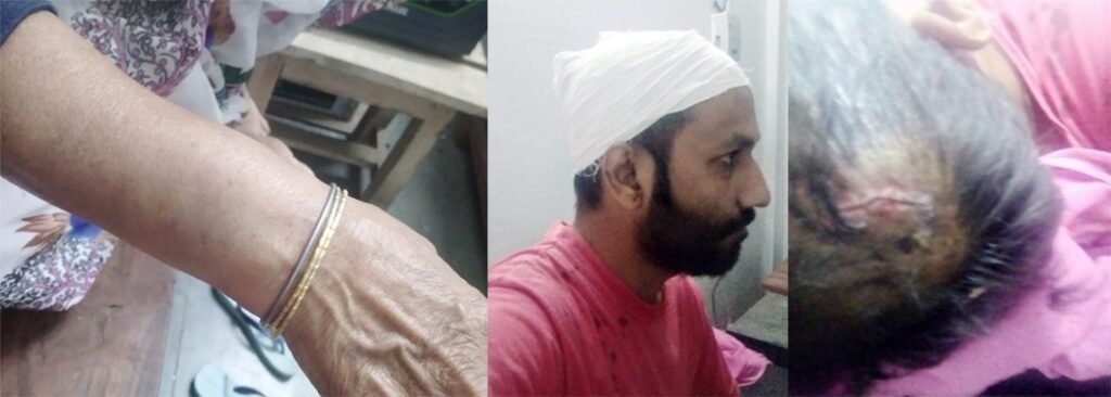 चोरी से खेत में पाइप बिछाकर सिंचाई के विवाद में फूटे सिर, 3 घायल