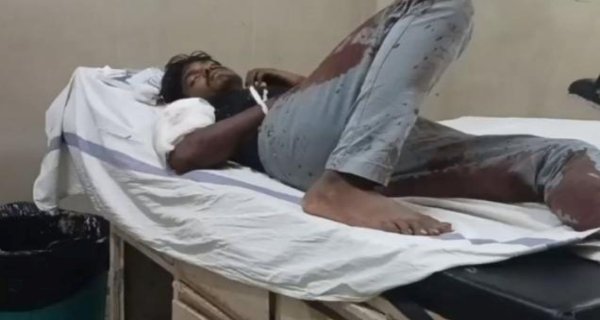ताला खोलते समय कट्टे का ट्रिगर दबा, युवक घायल, हालत गंभीर